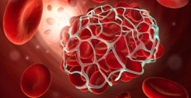 Angiom im Gehirn entfernen lassen. Bildquelle: psdesign1 – Fotolia.com